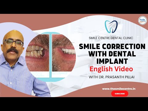 Smile correction with Dental Implant at Smile Centre India, Kochi