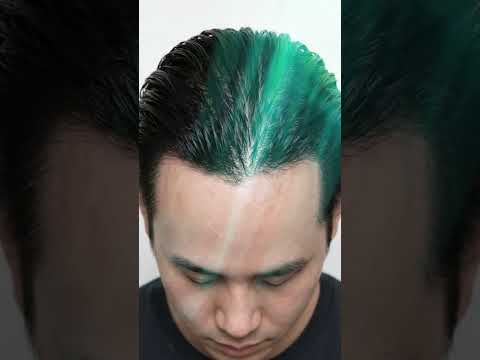 Detailed Insight into Managing TRT Hair Loss and Planning a Hair Transplant in Istanbul, Turkey