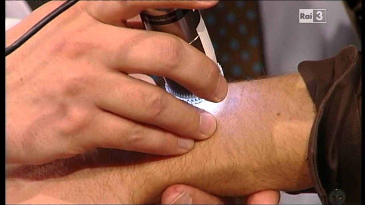 Watch Now Nei: epiluminescenza Nei: epiluminescenza