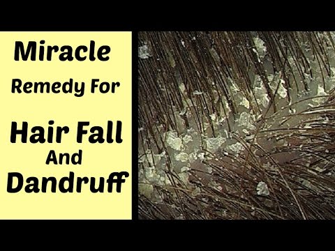 How to Remove Dandruff from Hair at Home || Miracle Cure for Dandruff Video