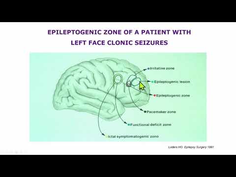 AES 2023 Epilepsy Specialist Symposium | The Frontal Lobe: Bermuda's Triangle
