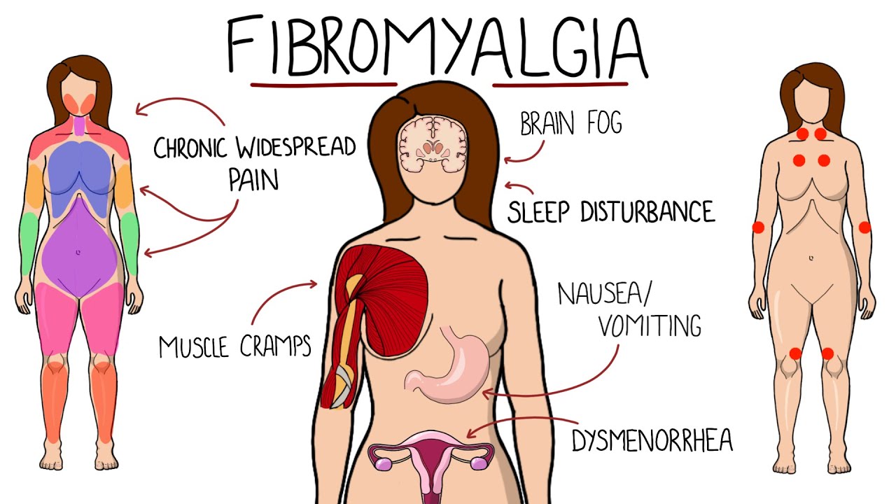 Fibromyalgia - A Chronic Pain Disorder (Includes Symptoms, Criteria & Treatment Options)
