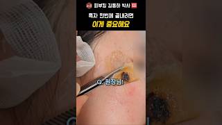 흑자 치료 1년 경과 보고: 뿌리 깊이 파악이 재발을 막는다