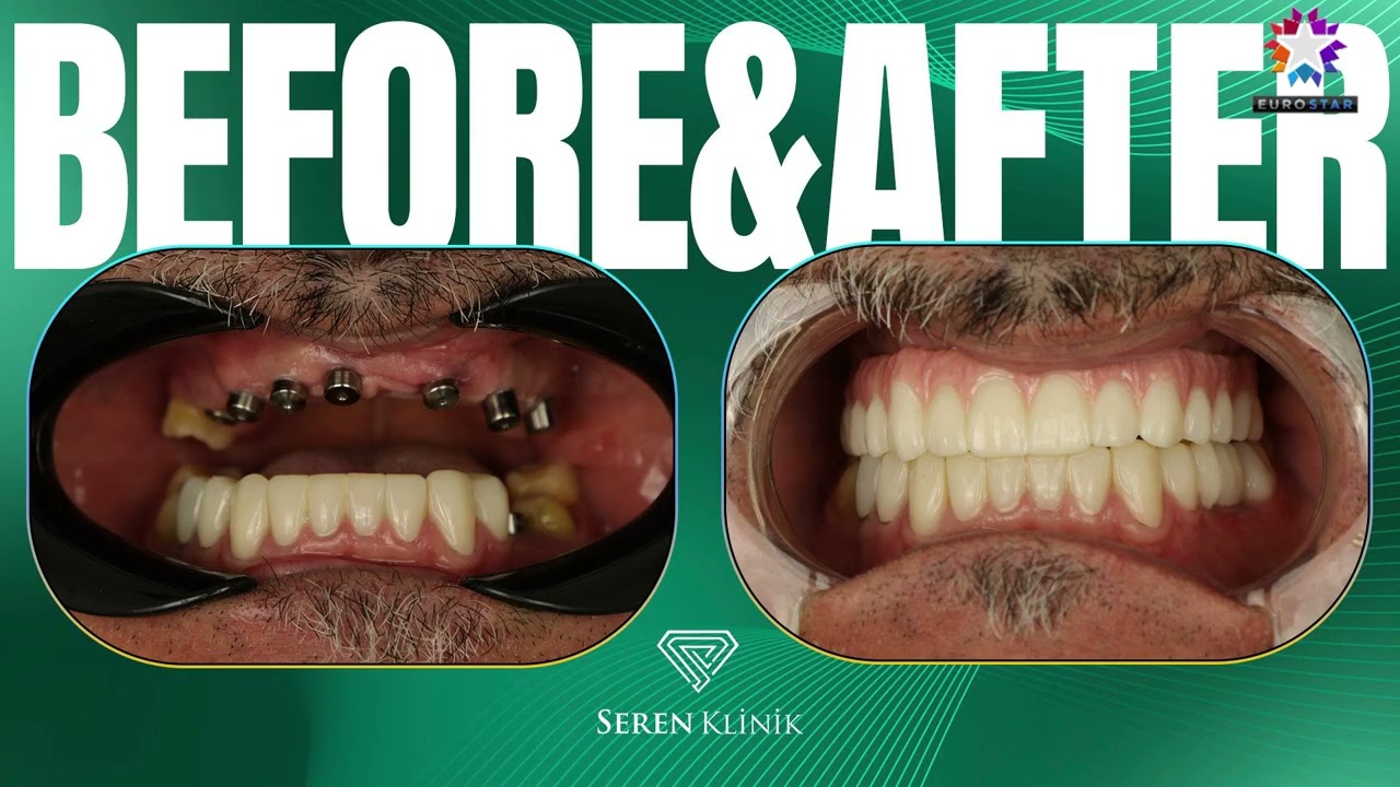 🦷✨ SEREN CLINIC | İstanbul Zeytinburnu’nda VIP Diş Tedavisi & Sağlık Turizmi