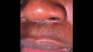 Upper lip twitch