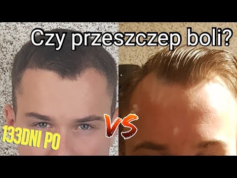 download lagu mp3 mp4 Przeszczep Wosw Fue, download lagu Przeszczep Wosw Fue gratis, unduh video klip Przeszczep Wosw Fue