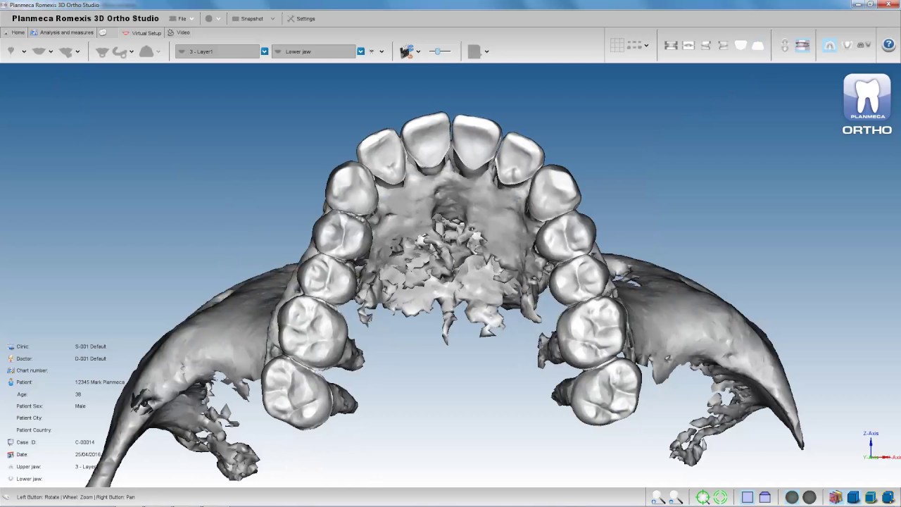 Planmeca Romexis 3D Ortho Studio – Orthodontic treatment planning with roots and bone surface