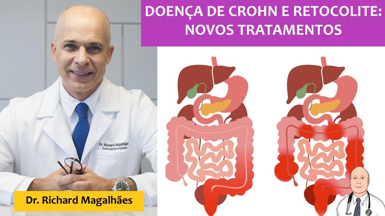 Sintomas, diagnóstico e novos tratamentos das doenças inflamatórias intestinais