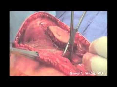 Osteosarcoma Resection Of The Humerus Proximal End - Part 1/6