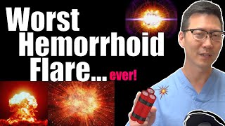 The WORST type of hemorrhoid flare and what to do! | Internal hemorrhoid thrombosis