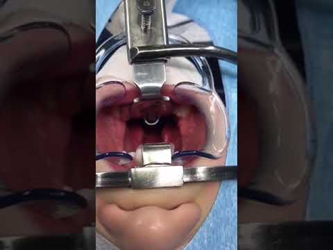 Qualcosa scricchiolio nellarticolazione del ginocchio Polso spostato trattamento delle fratture