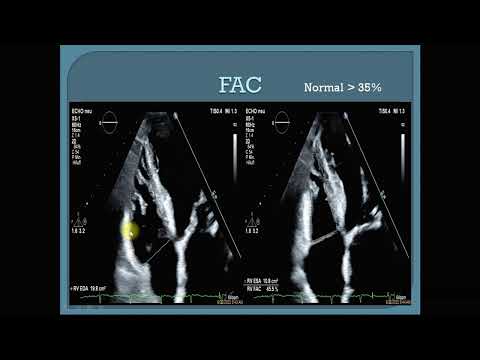 Comprehensive Assessment of the right ventricular function