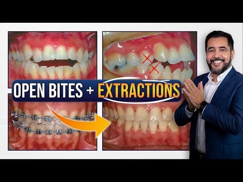 Anterior OPEN BITE - Extractions