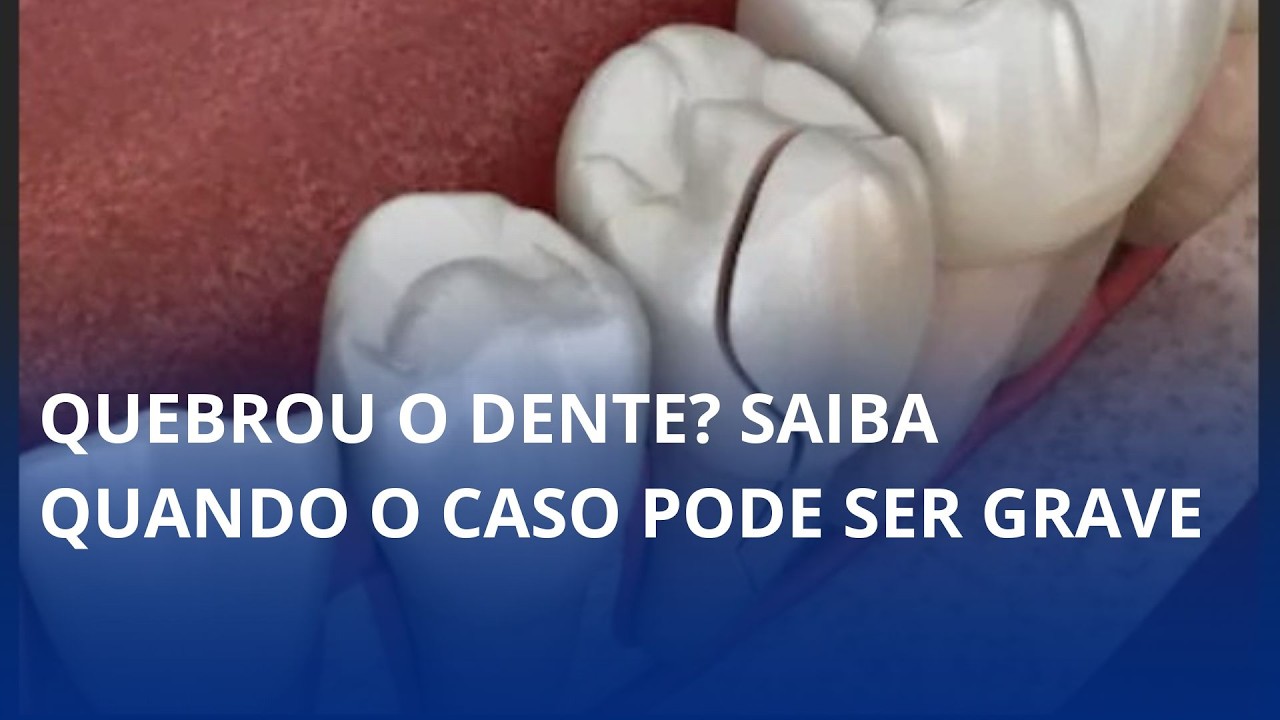 Fratura dental pode atingir nervos e exige atendimento imediato, alerta especialista