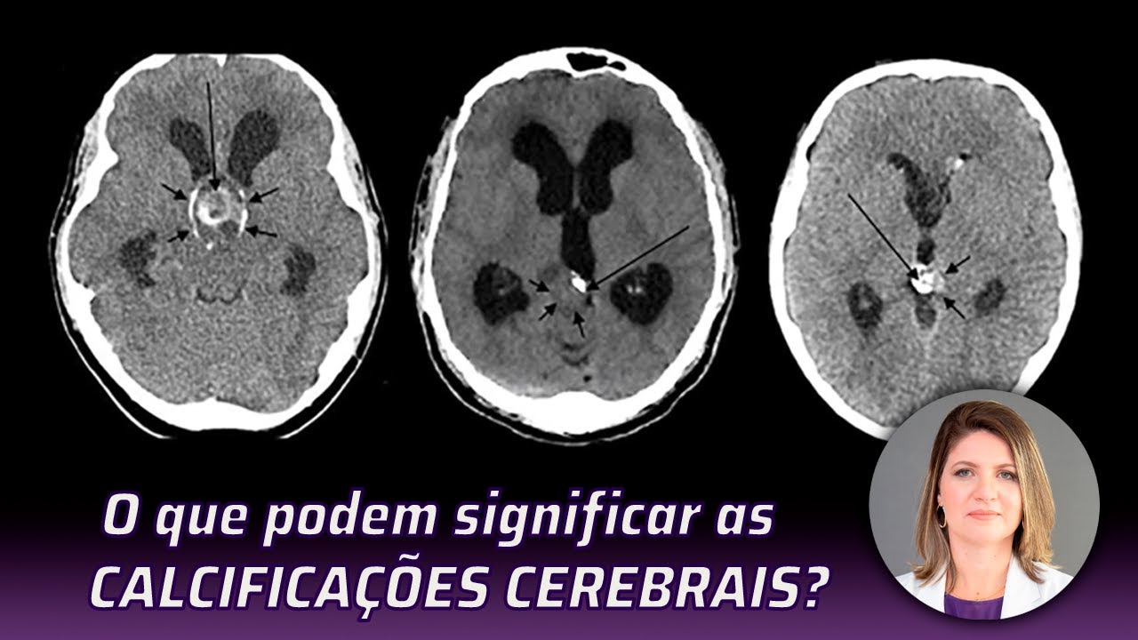 O QUE PODEM SIGNIFICAR AS CALCIFICAÇÕES CEREBRAIS
