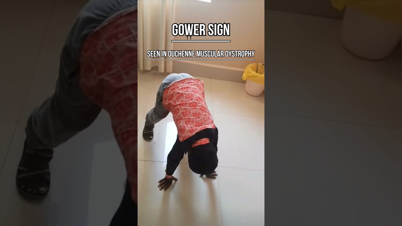 Gowers Sign in Duchenne Muscular Dystrophy