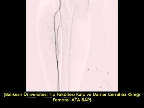 Femoral ATA BAP Balloon Angioplasty