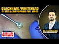 BLACKHEAD/WHITEHEAD/CYSTIC ACNE POPPING FULL VIDEO BLACKHEAD/WHITEHEAD/CYSTIC ACNE POPPING FULL VIDEO