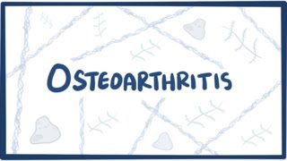 Download Lagu Osteoarthritis - causes, symptoms, diagnosis, treatment u0026 pathology Thumbnail