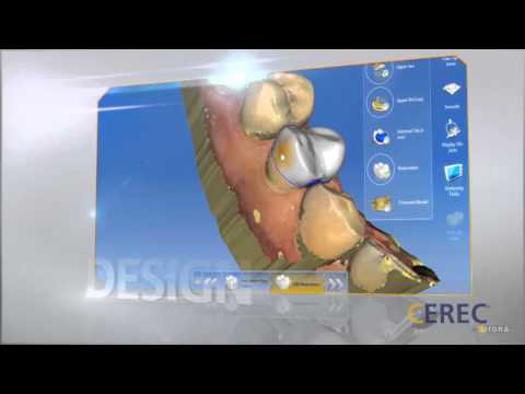 CEREC Omnicam One Visit Dentistry
