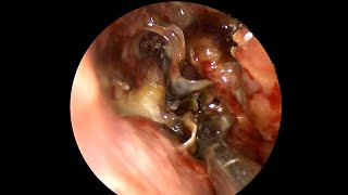 MUCORMYCOSIS Post - Op Sino-Nasal Washes &amp; Routine Endoscopy to check for RE-Infection of Fungus