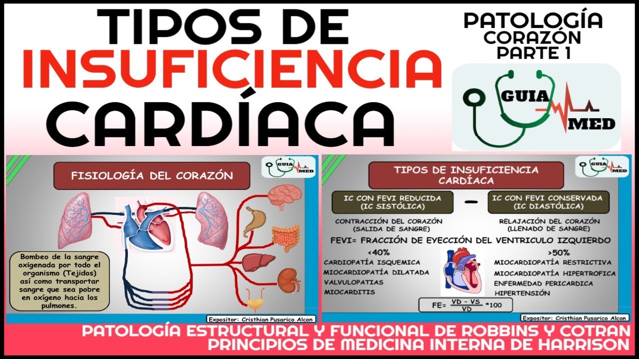 INSUFICIENCIA CARDÍACA DERECHA E IZQUIERDA FISIOPATOLOGÍA | GuiaMed