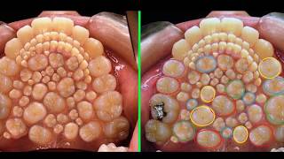 Hyperdontia Image a Hoax; Doctors remove 232 TEETH from boy's MOUTH in a Record-Breaking operation