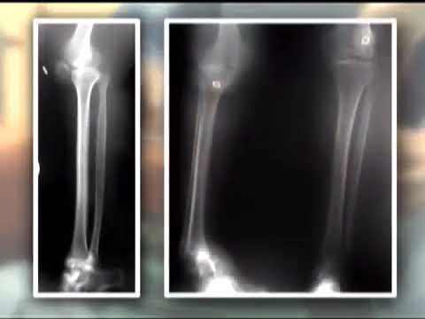 Distal Tibial Reconstruction with Use of an External Fixator and an Intramedullary Nail