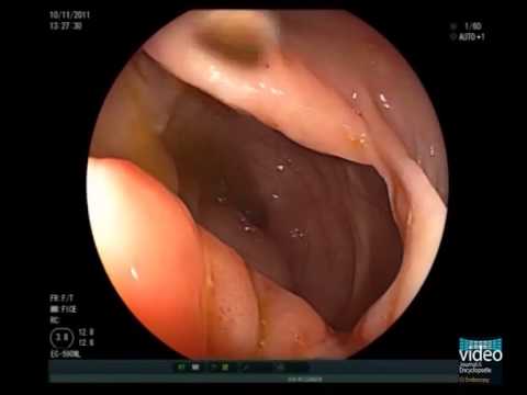 Nonsteroidal Anti-inflammatory Drug Induced Colonic Ulcer