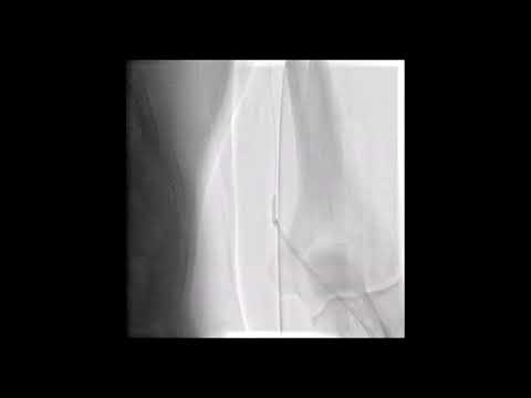 How to progress from radial artery spasm?  Balloon assisted tracking technique.