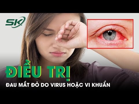 , title : 'Cách Điều Trị Đau Mắt Đỏ Do Virus Hoặc Vi Khuẩn | SKĐS'