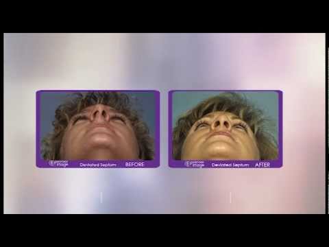 Correcting the Deviated Septum