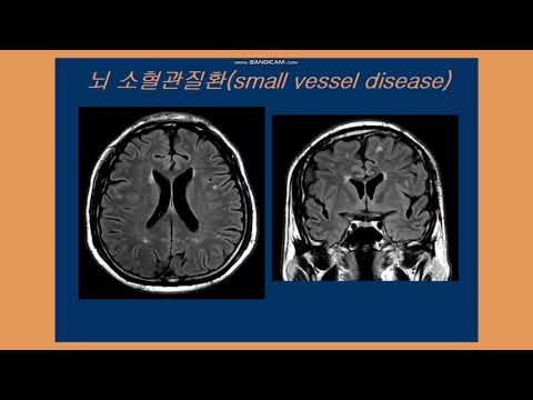 뇌 소혈관질환진단