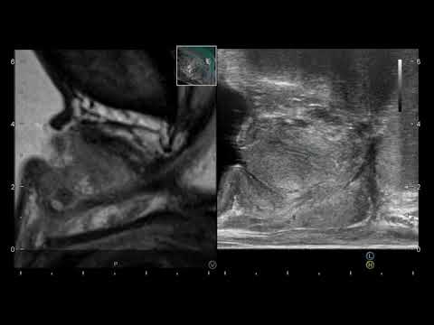 Trattamento della prostata indigal Analisi sul cane in prostatite cronica