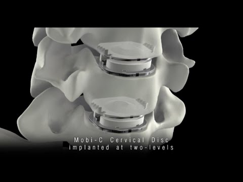 Mobi-C® Cervical Disc