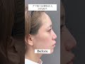 【20代女性】クマ取り＋脂肪注入で劇変…！！#美容整形 #美容医療 #お茶の水美容形成クリニック #クマ取り #クマ治療