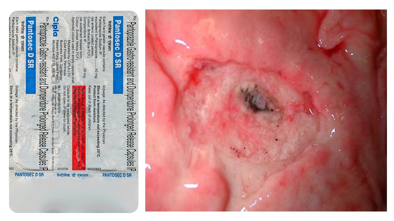 Pantosec D SR Capsule = Medicine for Ulcer and Vomiting | पेट के अलसर और उलटी में उपयोगी दवाई