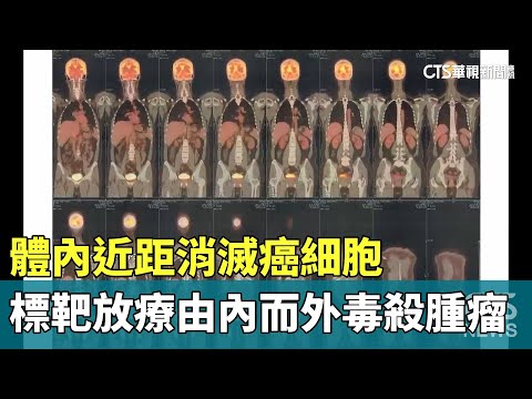 體內近距消滅癌細胞　標靶放療由內而外「毒殺」腫瘤