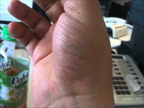 Fasciculation (muscle twitch)