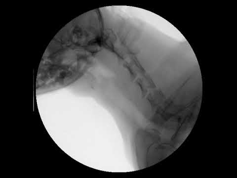 Canine mainstem bronchial and tracheal collapse (fluoroscopy)