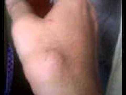 Kuko halamang-singaw sa iyong mga paa kaysa sa paggamot na may mga larawan Kaysa sa paggamot sa daliri mula pagpindot sa nail naka-black