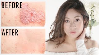 Psoriasis | How To Get Rid of Itchy Scaly Skin | Vivienne Fung