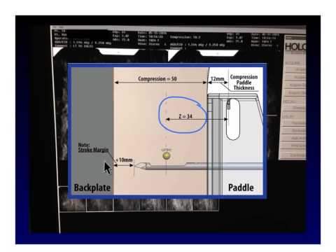 stereotaticCoreBiopsy