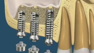 Cấy Ghép Implant - Nâng Xoang Hàm Khi Trồng Răng Implant