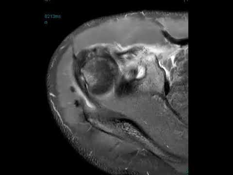 Hilli-Sachs and Bankart lesion from dislocation. MGHL tear and coracoid process fracture.