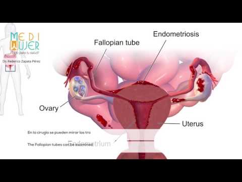Endometriosis, MediMujer, Dr. Federico Zapata, (574) 235 4280 Medellín