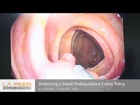 Colorectal Videos