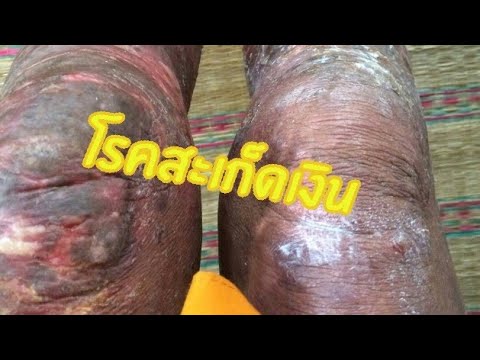 โรคสะเก็ดเงิน Palmar-ฝ่าเท้าบนเท้า ครีมสำหรับโรคสะเก็ดเงินบนมือและเท้า