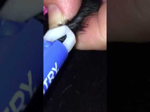 Tick removal