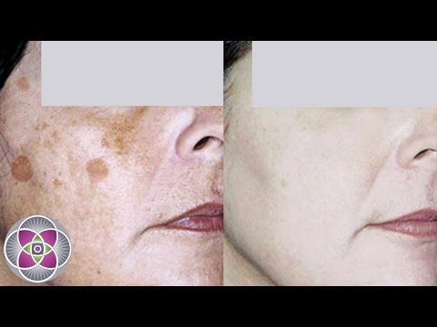La crema che candeggia skinoren Persona di pigmentazione di Yandex
